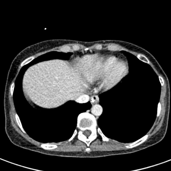 File:Adhesional small bowel obstruction (Radiopaedia 48397-53305 Axial C+ portal venous phase 3).jpg