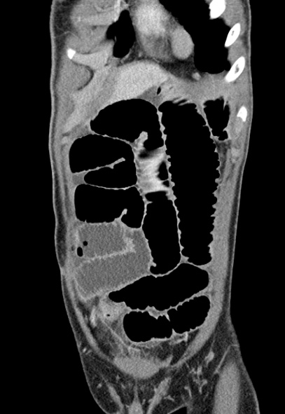 Adhesional small bowel obstruction (Radiopaedia 52107-57980 Coronal C+ portal venous phase 13).jpg