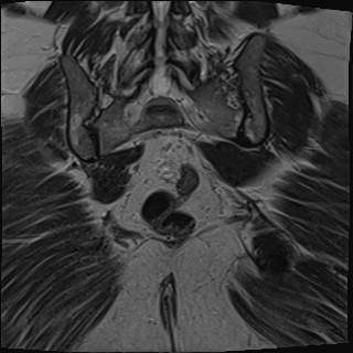 File:Adnexal multilocular cyst (O-RADS US 3- O-RADS MRI 3) (Radiopaedia 87426-103754 Coronal T2 27).jpg