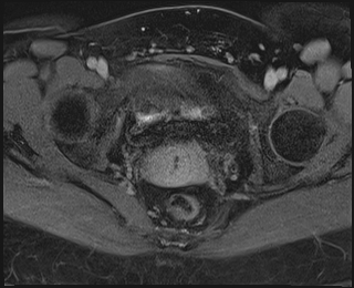 File:Adnexal multilocular cyst (O-RADS US 3. O-RADS MRI 3) (Radiopaedia 87426-103754 Axial 238).jpeg