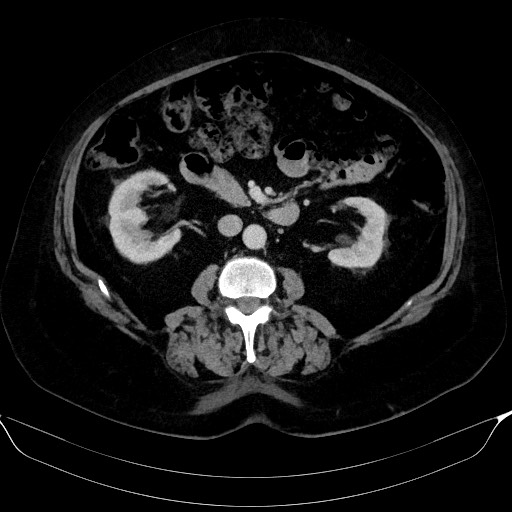 Adrenal cortical carcinoma (Radiopaedia 64017-72769 Axial C+ portal venous phase 32).jpg