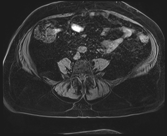 Adrenal cortical carcinoma (Radiopaedia 64017-72770 Axial T1 C+ fat sat 53).jpg