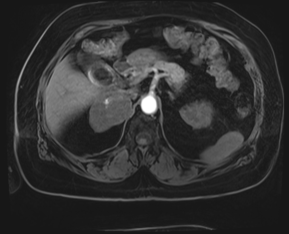 Adrenal cortical carcinoma (Radiopaedia 64017-72770 H 10).jpg