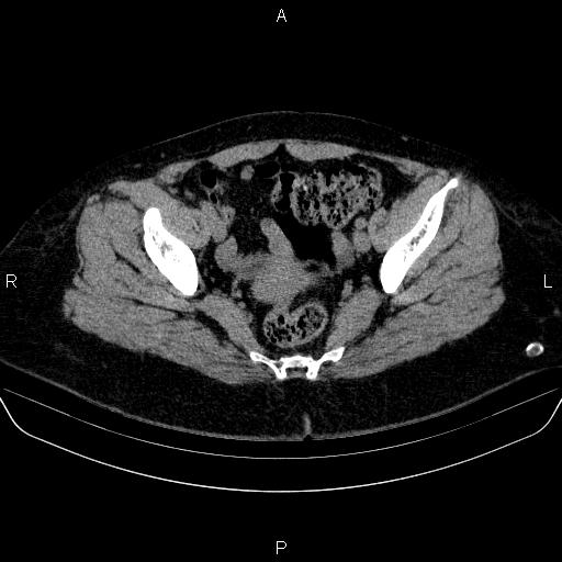 File:Adrenal cortical carcinoma (Radiopaedia 84882-100379 Axial non-contrast 83).jpg