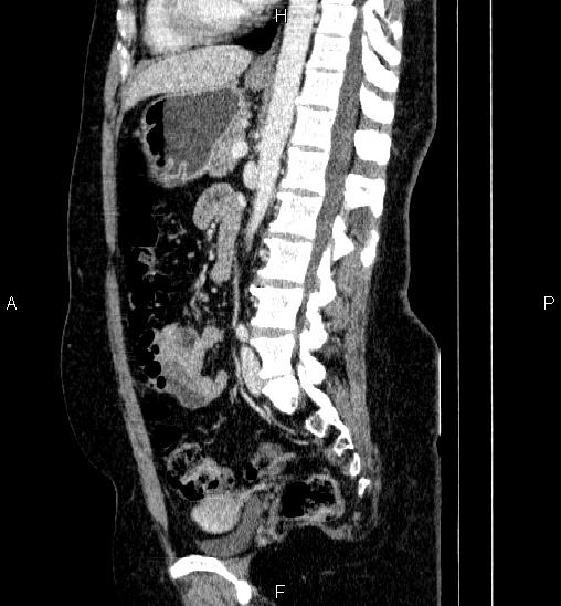 File:Adrenal cortical carcinoma (Radiopaedia 84882-100379 Sagittal C+ portal venous phase 51).jpg
