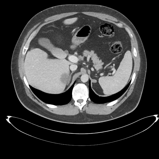File:Adrenal cyst (Radiopaedia 45625-49778 AXIAL THICK 60 sec 14).png