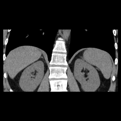 Adrenal gland trauma (Radiopaedia 81351-95079 Coronal non-contrast 62).jpg