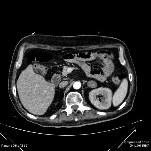 Adrenal metastasis (Radiopaedia 78425-91079 Axial C+ arterial phase 36).jpg