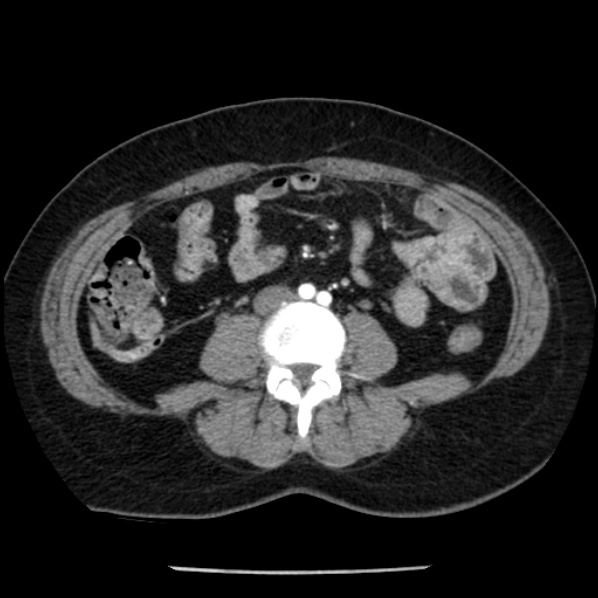 Adrenal myelolipoma (Radiopaedia 43401-46759 Axial C+ arterial phase 60).jpg