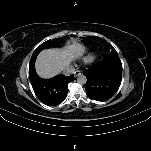 Adrenal myelolipoma (Radiopaedia 82742-96986 Axial non-contrast 5).jpg