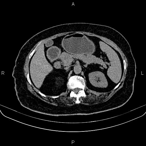 Adrenal myelolipoma (Radiopaedia 82742-96986 Axial non-contrast 52).jpg