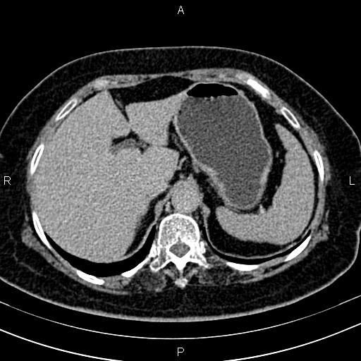 Adrenal myelolipoma (Radiopaedia 82742-96986 Axial renal excretory phase 28).jpg