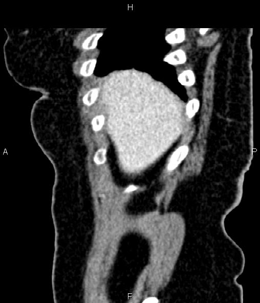Adrenal myelolipoma (Radiopaedia 82742-96986 Sagittal renal cortical phase 17).jpg