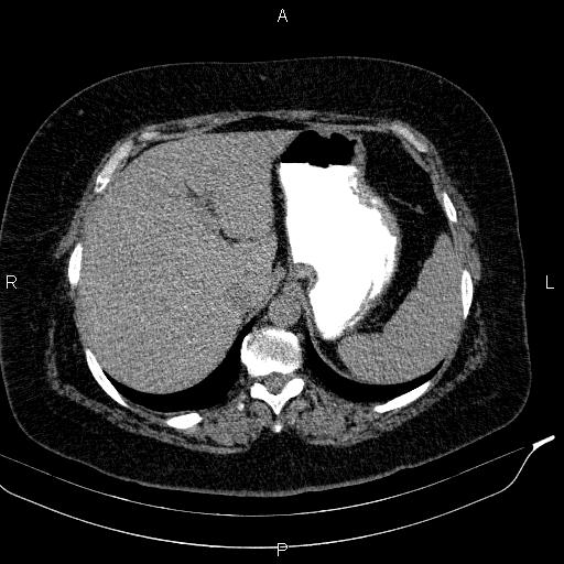 File:Adrenal myelolipoma (Radiopaedia 84319-99617 Axial With oral contrast 47).jpg
