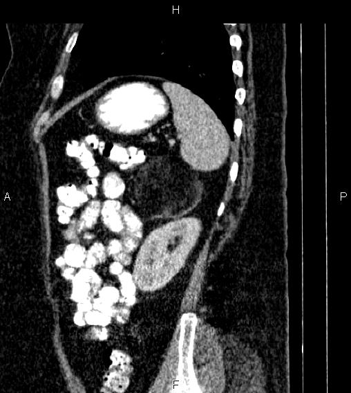 Adrenal myelolipoma (Radiopaedia 84319-99617 Sagittal renal cortical phase 76).jpg