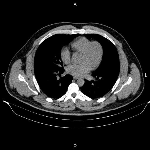 Adrenal myelolipoma (Radiopaedia 84321-99619 Axial non-contrast 1).jpg