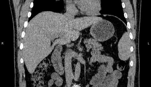 Adrenal myelolipoma (Radiopaedia 84321-99619 Coronal non-contrast 39).jpg