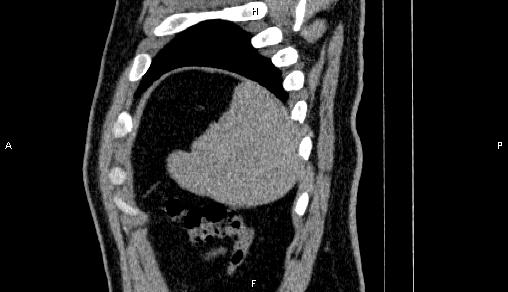 Adrenal myelolipoma (Radiopaedia 84321-99619 Sagittal non-contrast 98).jpg