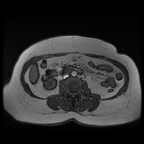 File:Adrenal myelolipoma - MRI (Radiopaedia 83249-97646 T1 out-of-phase 20).jpg