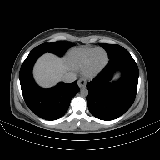 Adrenal myelolipoma - bilateral (Radiopaedia 74805-85810 Axial non-contrast 5).jpg