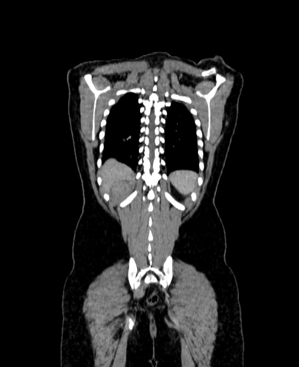 Adrenocortical carcinoma (Radiopaedia 80134-93438 Coronal C+ portal venous phase 139).jpg
