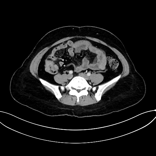 Adrenocortical carcinoma (Radiopaedia 87281-103569 Axial C+ portal venous phase 59).jpg