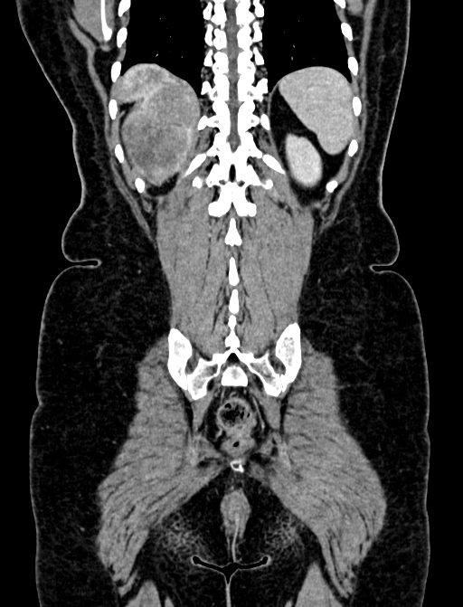 Adrenocortical carcinoma (Radiopaedia 87281-103569 Coronal C+ portal venous phase 125).jpg