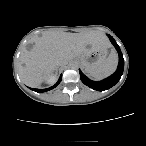 Adult polycystic kidney disease (Radiopaedia 48845-53876 Axial renal excretory phase 25).jpg