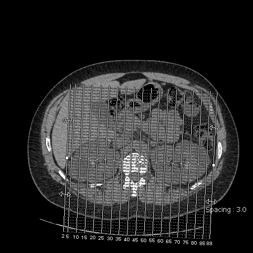 Adult polycystic kidney disease (Radiopaedia 59075-66368 Sagittal non-contrast 1).jpg