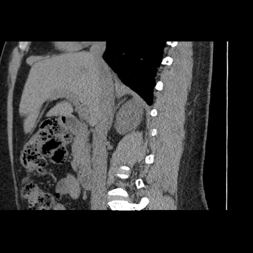 Adult polycystic kidney disease (Radiopaedia 59075-66368 Sagittal non-contrast 32).jpg