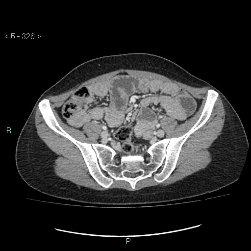 Adult transient intestinal intussusception (Radiopaedia 34853-36310 Axial C+ portal venous phase 78).jpg