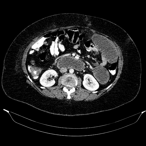 Afferent loop syndrome - secondary to incarcerated trocar site hernia (Radiopaedia 82959-97305 Axial C+ portal venous phase 106).jpg