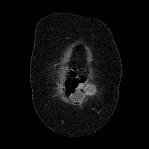 File:Afferent loop syndrome - secondary to incarcerated trocar site hernia (Radiopaedia 82959-97305 Coronal C+ portal venous phase 23).jpg