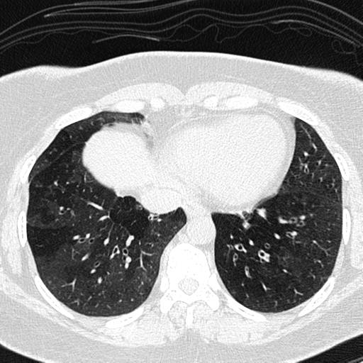 File:Air trapping in small airway disease (Radiopaedia 61685-69694 Axial lung window 132).jpg
