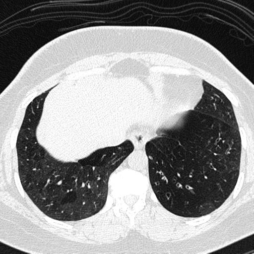 File:Air trapping in small airway disease (Radiopaedia 61685-69694 Axial lung window 149).jpg