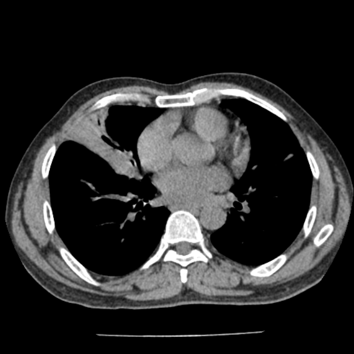 Airway foreign body in adult (Radiopaedia 85907-101779 Axial liver window 108).jpg