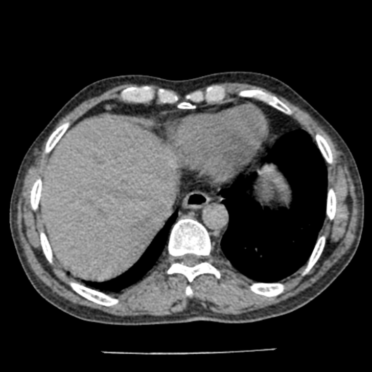 Airway foreign body in adult (Radiopaedia 85907-101779 Axial liver window 155).jpg