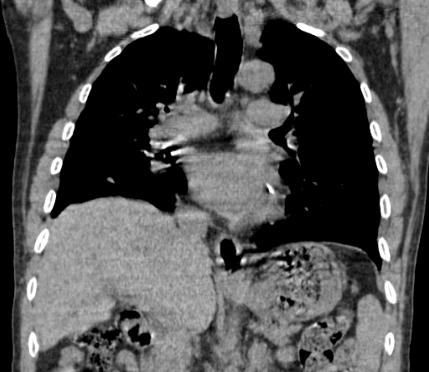 Airway foreign body in adult (Radiopaedia 85907-101779 Coronal liver window 137).jpg