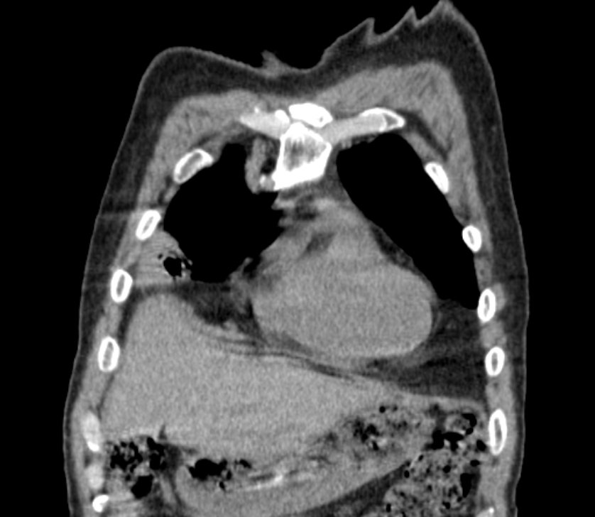Airway foreign body in adult (Radiopaedia 85907-101779 Coronal liver window 38).jpg
