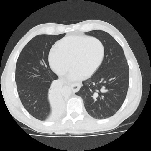 File:Allergic bronchopulmonary aspergillosis (ABPA) (Radiopaedia 60594-68313 Axial lung window 41).jpg