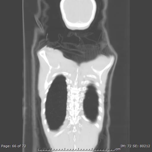 File:Alpha-1-antitrypsin deficiency (Radiopaedia 50561-55987 Coronal lung window 64).jpg