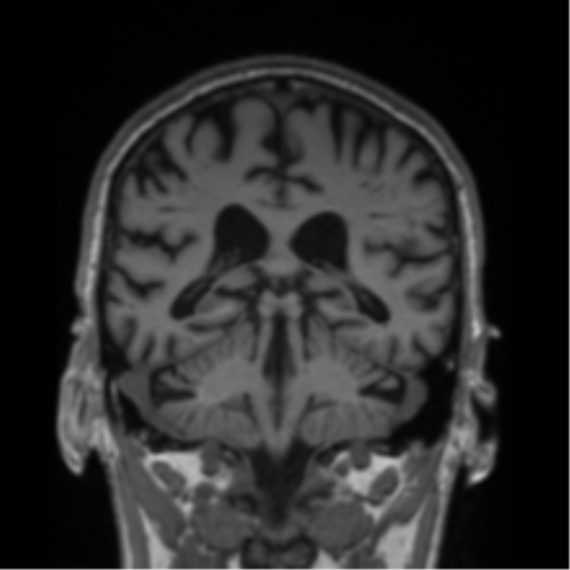 Alzheimer's disease- with Gerstmann syndrome and dressing apraxia (Radiopaedia 54882-61150 Coronal T1 35).png