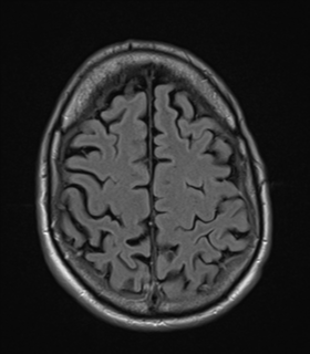 File:Alzheimer's disease- with apraxia (Radiopaedia 54763-61011 Axial FLAIR 22).png