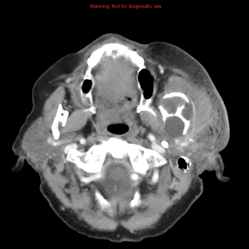 Ameloblastoma (Radiopaedia 27437-27631 A 26).jpg