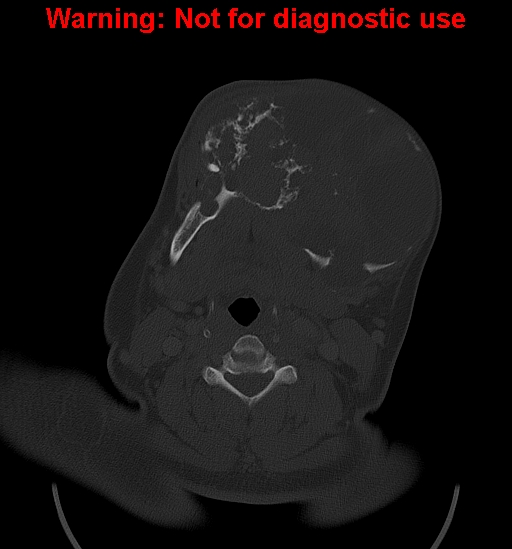 File:Ameloblastoma (Radiopaedia 33126-34164 Axial bone window 19).jpg