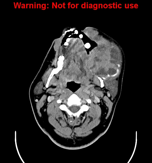 File:Ameloblastoma (Radiopaedia 33126-34164 B 8).jpg