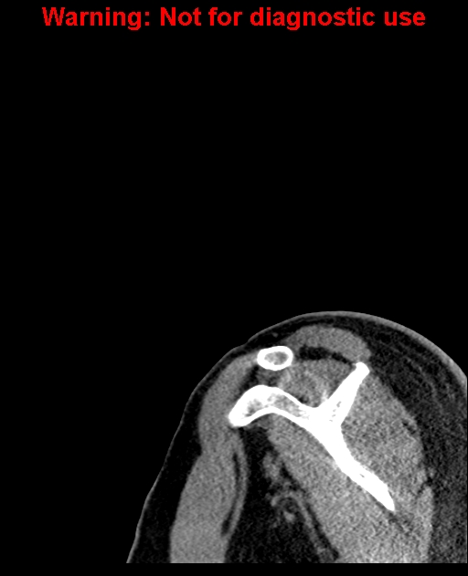Ameloblastoma (Radiopaedia 33126-34164 Sagittal bone window 1).jpg