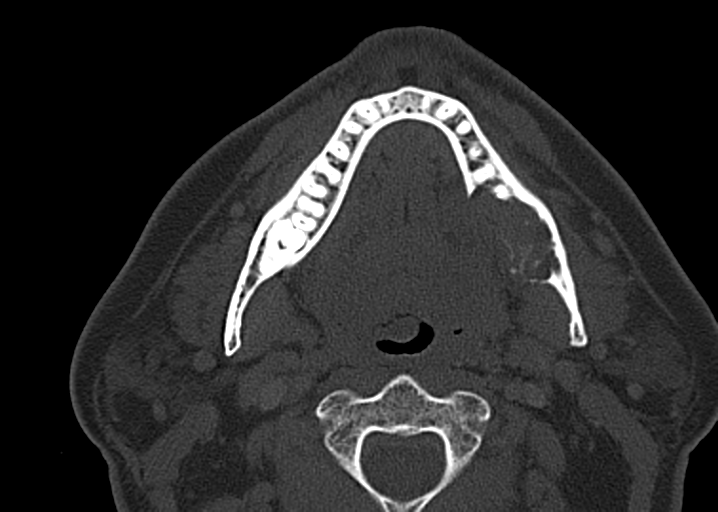 Ameloblastoma (Radiopaedia 38520-40623 D 32).png