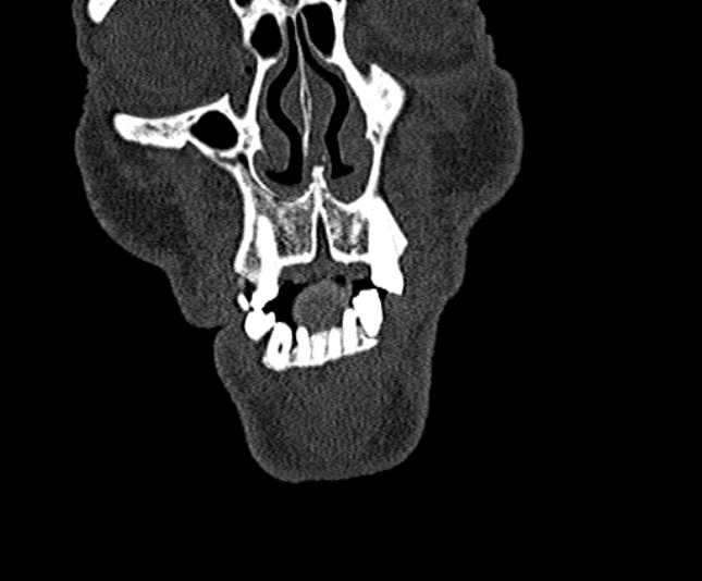 Ameloblastoma (Radiopaedia 51921-57766 Coronal bone window 24).jpg