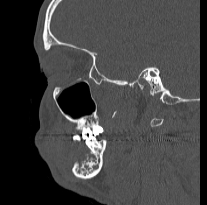 Ameloblastoma (Radiopaedia 77750-89997 Sagittal bone window 55).jpg